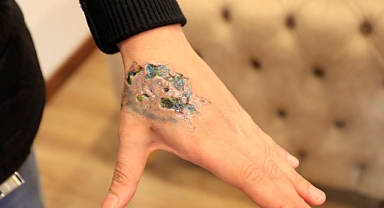 Dövme sildirmek isterken kabusu yaşadı 