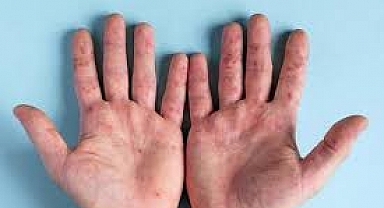 El ve ayaklarda ani mavi-mor renk değişimlerine dikkat